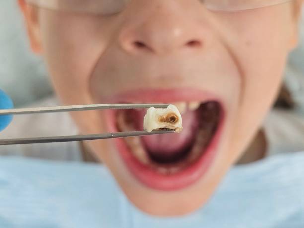 Best Emergency Dental Extractions in Centreville, MI