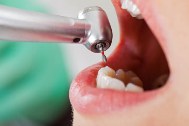 Best Emergency Dentist for Knocked-Out Tooth in Centreville, MI